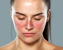 Lupus eritematoso sistêmico: sintomas, diagnóstico e tratamento